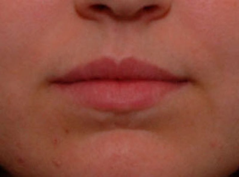 Lip Fillers Before & After Gallery - Patient 366432 - Image 1