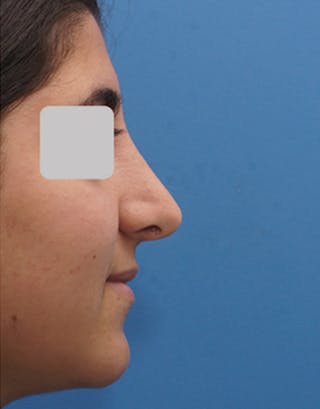 Rhinoplasty Before & After Gallery - Patient 553481 - Image 2