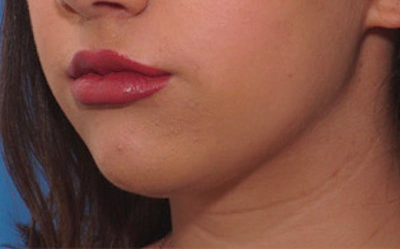 Chin Surgery Before & After Gallery - Patient 184973 - Image 8