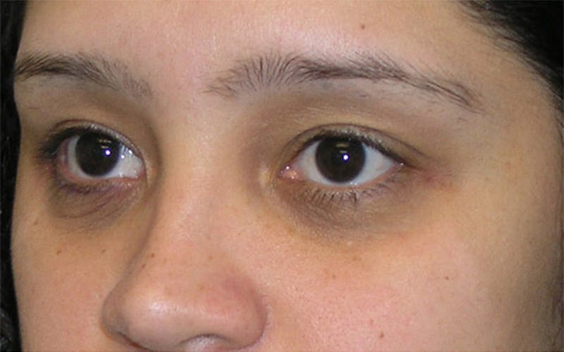 Eyelid Surgery Before & After Gallery - Patient 117908 - Image 5