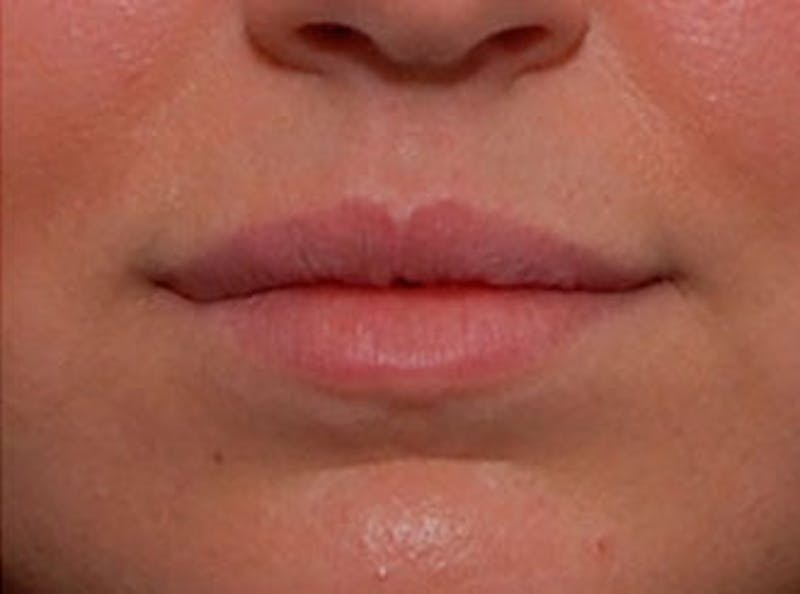 Lip Fillers Before & After Gallery - Patient 366432 - Image 2