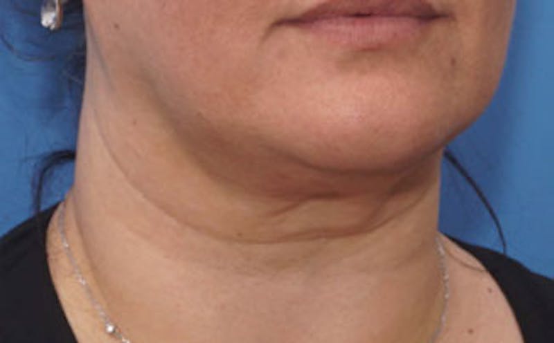 FaceTite Before & After Gallery - Patient 367914 - Image 1