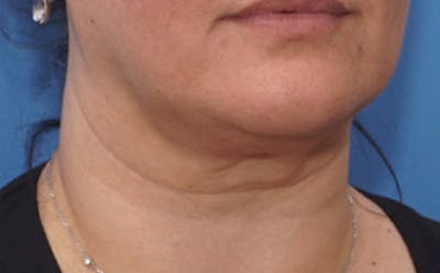 FaceTite Before & After Gallery - Patient 367914 - Image 1