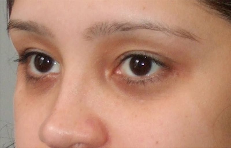 Eyelid Surgery Before & After Gallery - Patient 117908 - Image 6