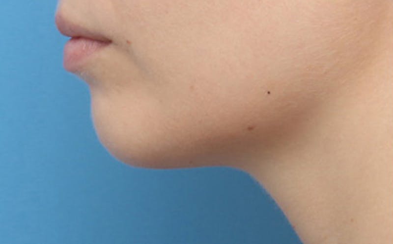 Chin Surgery Before & After Gallery - Patient 903637 - Image 1