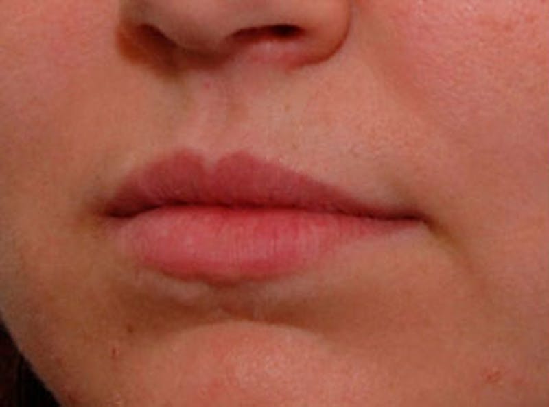 Lip Fillers Before & After Gallery - Patient 366432 - Image 3