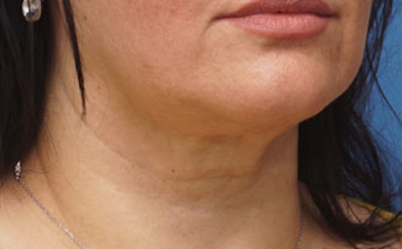 FaceTite Before & After Gallery - Patient 367914 - Image 2
