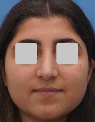 Rhinoplasty Before & After Gallery - Patient 553481 - Image 4