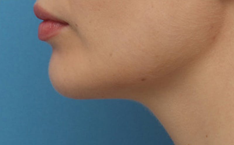 Chin Surgery Before & After Gallery - Patient 903637 - Image 2