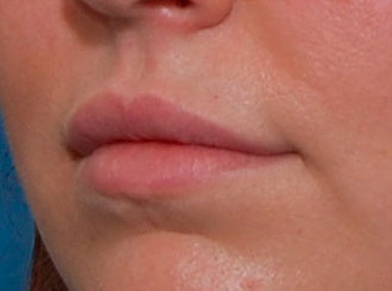 Lip Fillers Before & After Gallery - Patient 366432 - Image 4