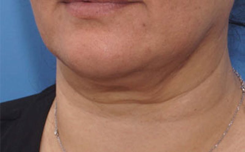 FaceTite Before & After Gallery - Patient 367914 - Image 3