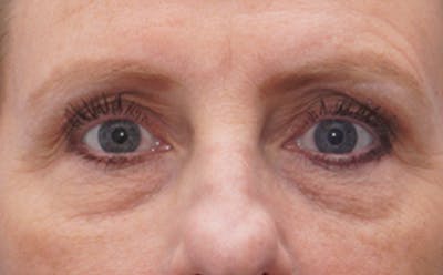 Eyelid Surgery Before & After Gallery - Patient 187680 - Image 1