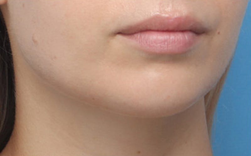 Chin Surgery Before & After Gallery - Patient 903637 - Image 3