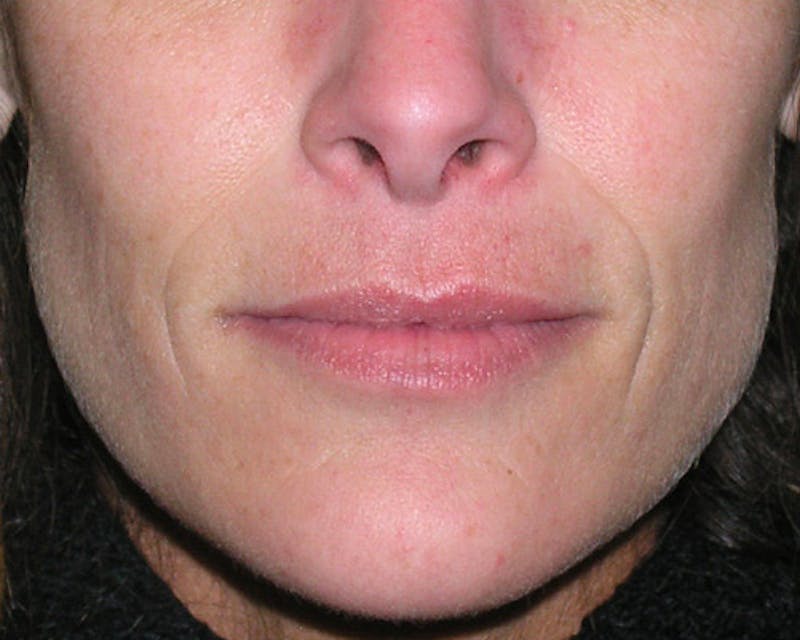 Fillers Before & After Gallery - Patient 358814 - Image 1