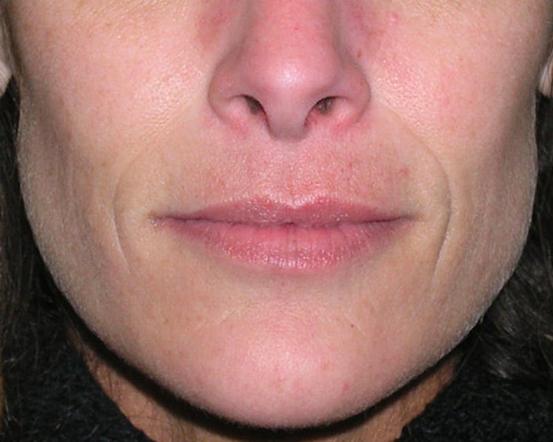 Patient OJIU9_L4QqWx6IkyED52zw - Fillers Before & After Photos