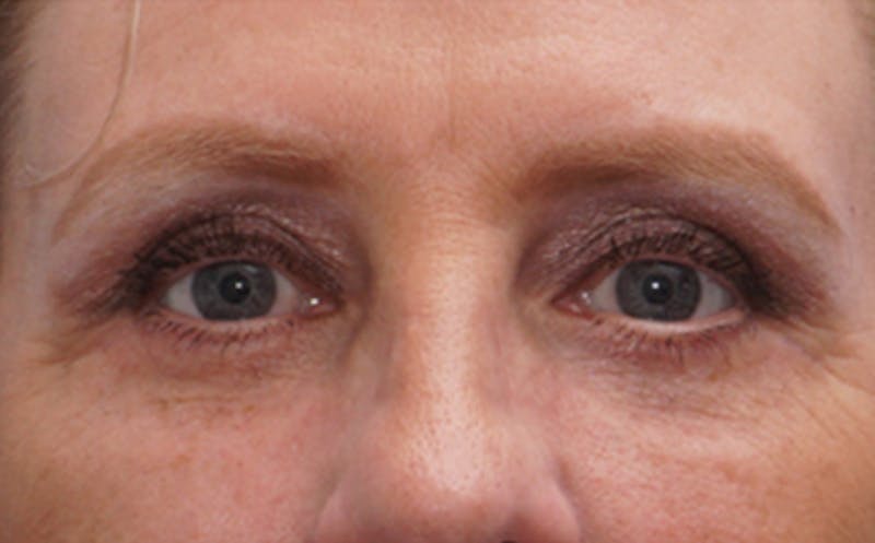 Eyelid Surgery Before & After Gallery - Patient 187680 - Image 2