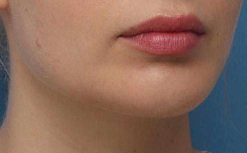 Chin Surgery Before & After Gallery - Patient 903637 - Image 4