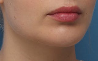 Chin Surgery Before & After Gallery - Patient 903637 - Image 4