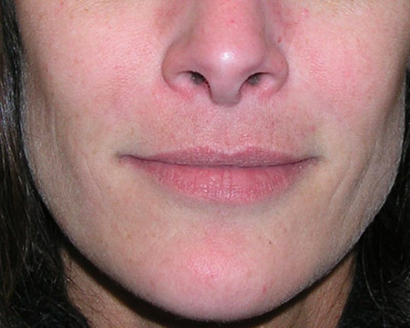 Fillers Before & After Gallery - Patient 358814 - Image 2