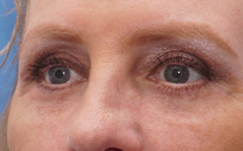 Eyelid Surgery Before & After Gallery - Patient 187680 - Image 3