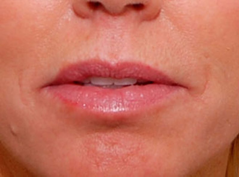 Lip Fillers Before & After Gallery - Patient 396385 - Image 1