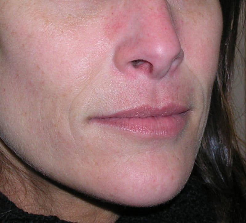 Fillers Before & After Gallery - Patient 358814 - Image 3