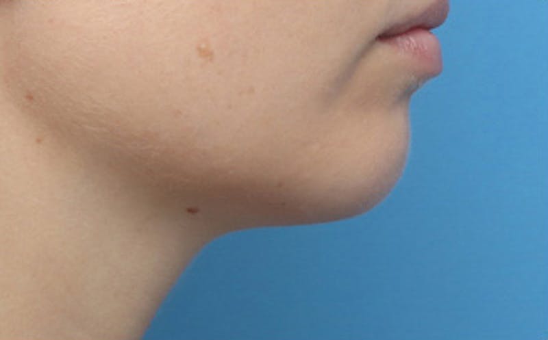 Chin Surgery Before & After Gallery - Patient 903637 - Image 5