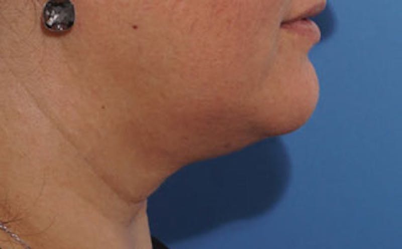 FaceTite Before & After Gallery - Patient 367914 - Image 7