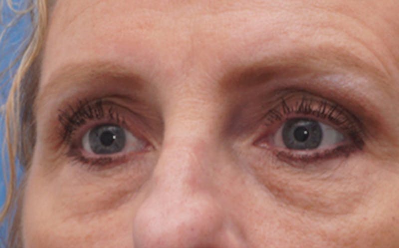 Eyelid Surgery Before & After Gallery - Patient 187680 - Image 4