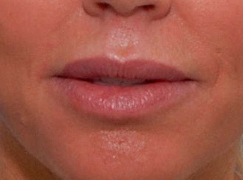 Lip Fillers Before & After Gallery - Patient 396385 - Image 2