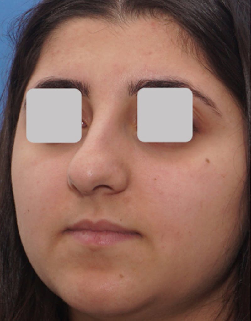 Rhinoplasty  Before & After Gallery - Patient 553481 - Image 7