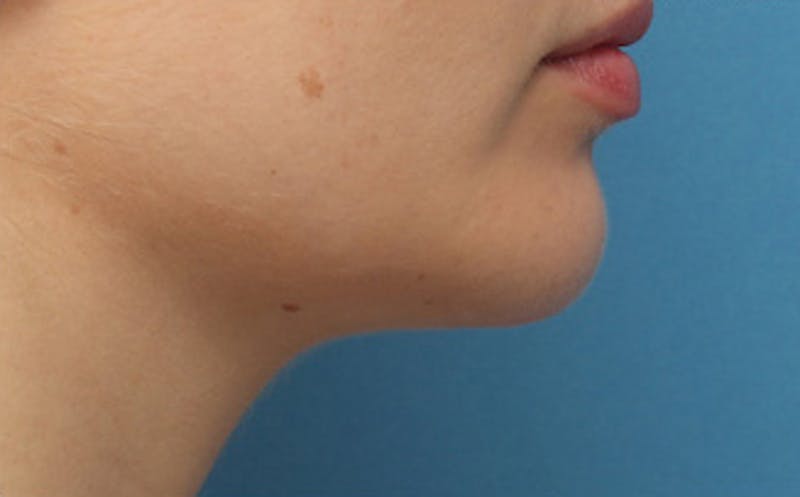 Chin Surgery Before & After Gallery - Patient 903637 - Image 6