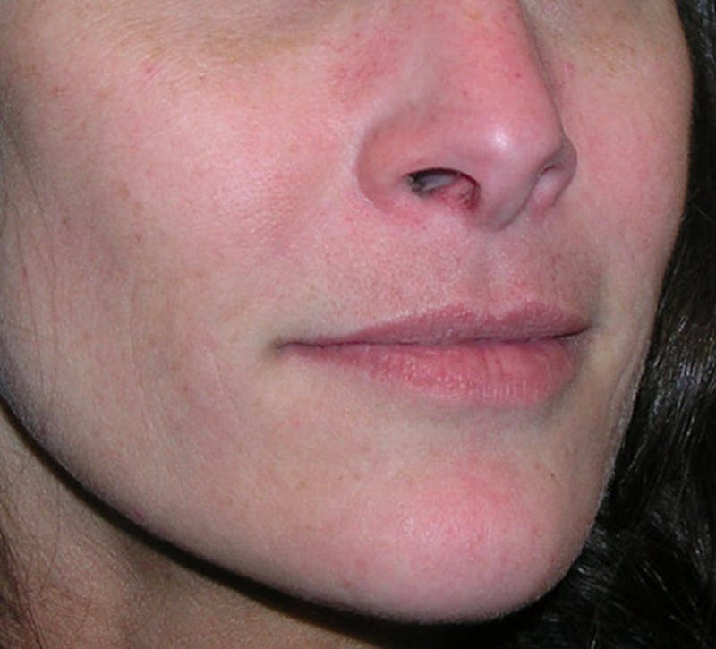 Fillers Before & After Gallery - Patient 358814 - Image 4