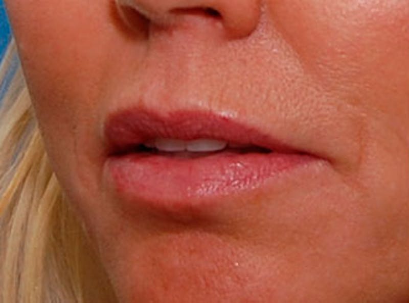 Lip Fillers Before & After Gallery - Patient 396385 - Image 3