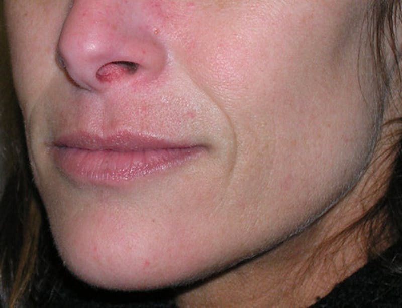 Fillers Before & After Gallery - Patient 358814 - Image 5