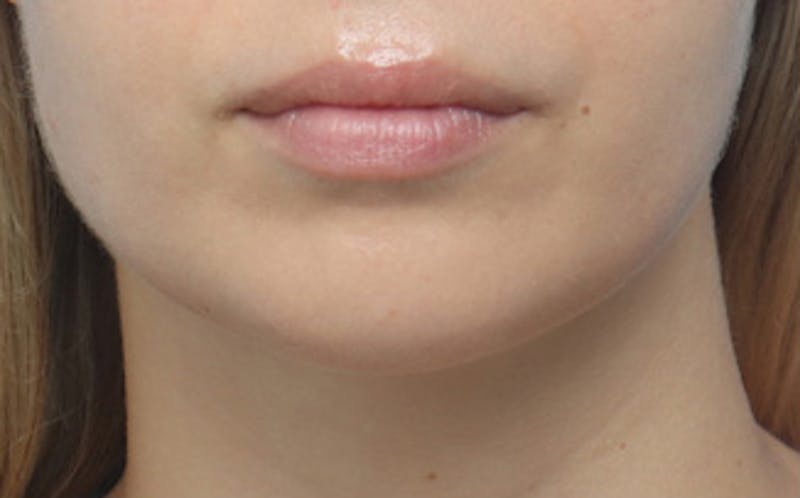 Chin Surgery Before & After Gallery - Patient 903637 - Image 7