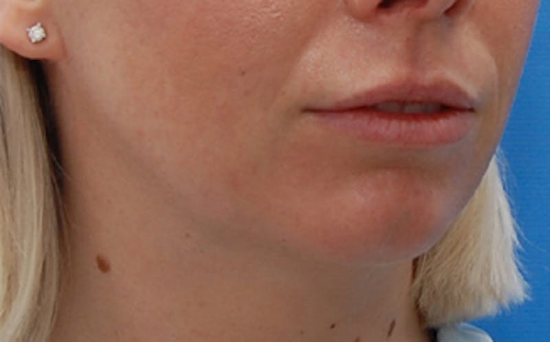 FaceTite Before & After Gallery - Patient 974169 - Image 1