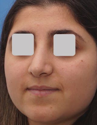 Rhinoplasty Before & After Gallery - Patient 553481 - Image 8