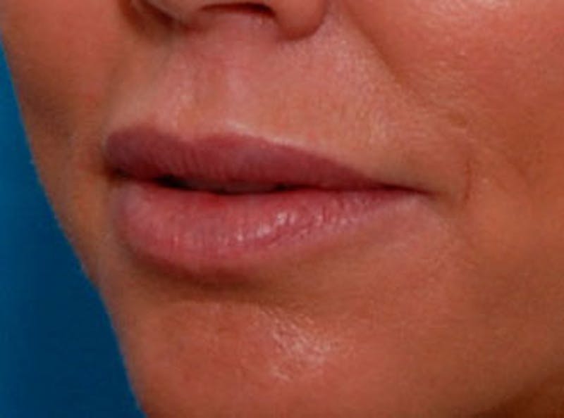 Lip Fillers Before & After Gallery - Patient 396385 - Image 4