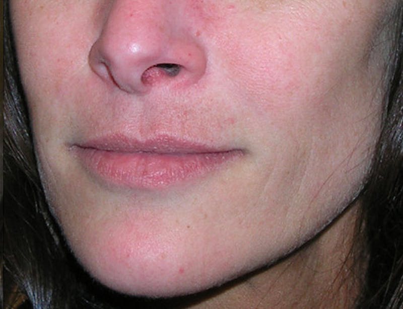 Fillers Before & After Gallery - Patient 358814 - Image 6