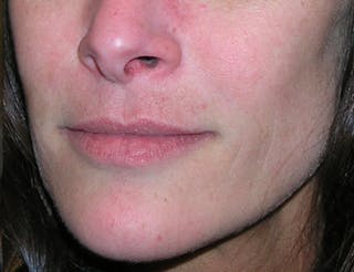 Fillers Before & After Gallery - Patient 358814 - Image 6