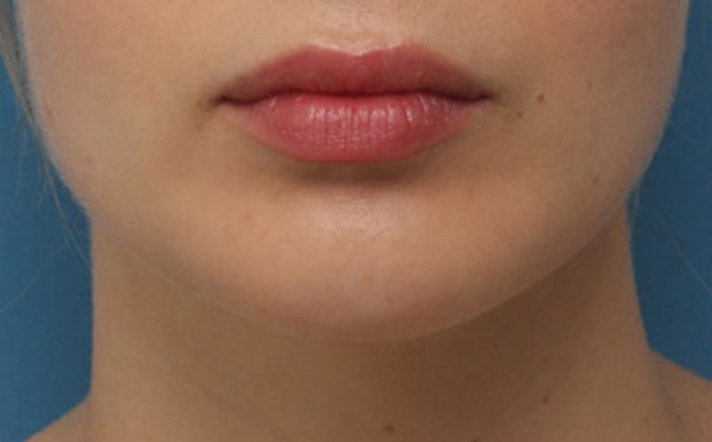 Chin Surgery Before & After Gallery - Patient 903637 - Image 8