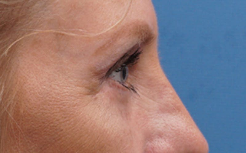 Eyelid Surgery Before & After Gallery - Patient 187680 - Image 7