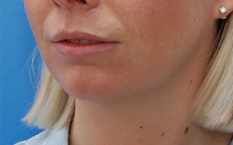 FaceTite Before & After Gallery - Patient 974169 - Image 3