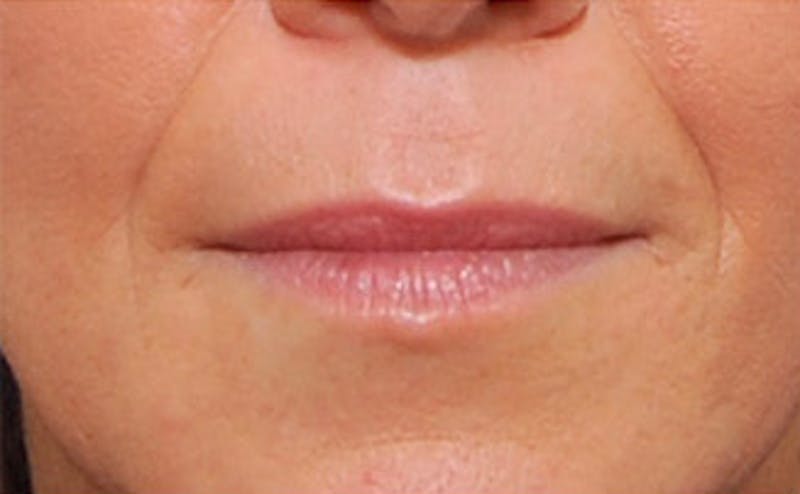 Patient KMKSA9VzQnuT_bRS40rblQ - Fillers Before & After Photos