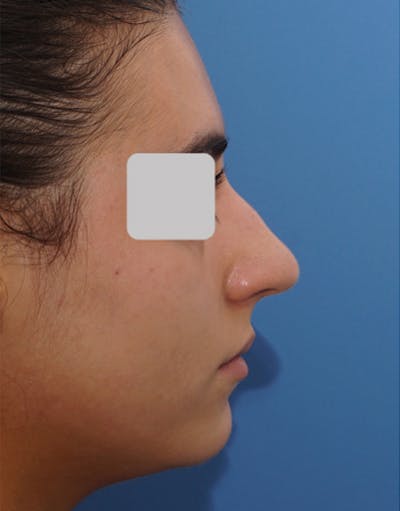 Rhinoplasty Before & After Gallery - Patient 255064 - Image 1