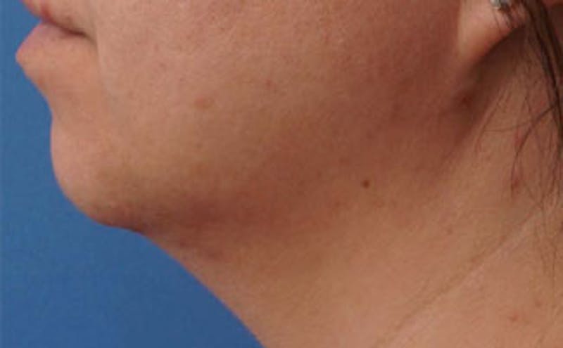 Chin Surgery Before & After Gallery - Patient 875047 - Image 1