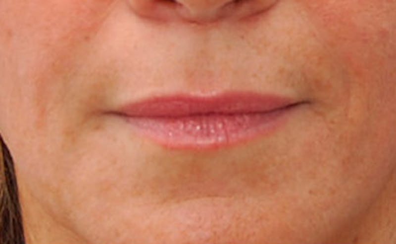 Fillers Before & After Gallery - Patient 361301 - Image 2