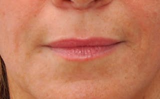 Fillers Before & After Gallery - Patient 361301 - Image 2