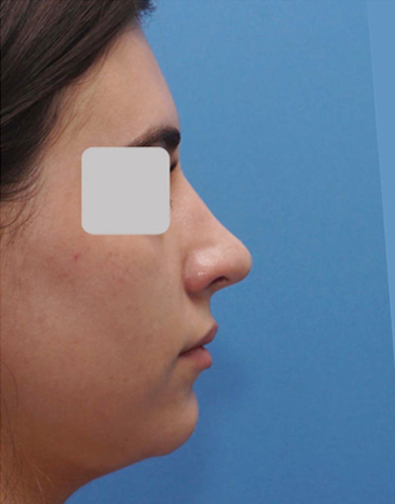 Rhinoplasty Before & After Gallery - Patient 564738 - Image 2